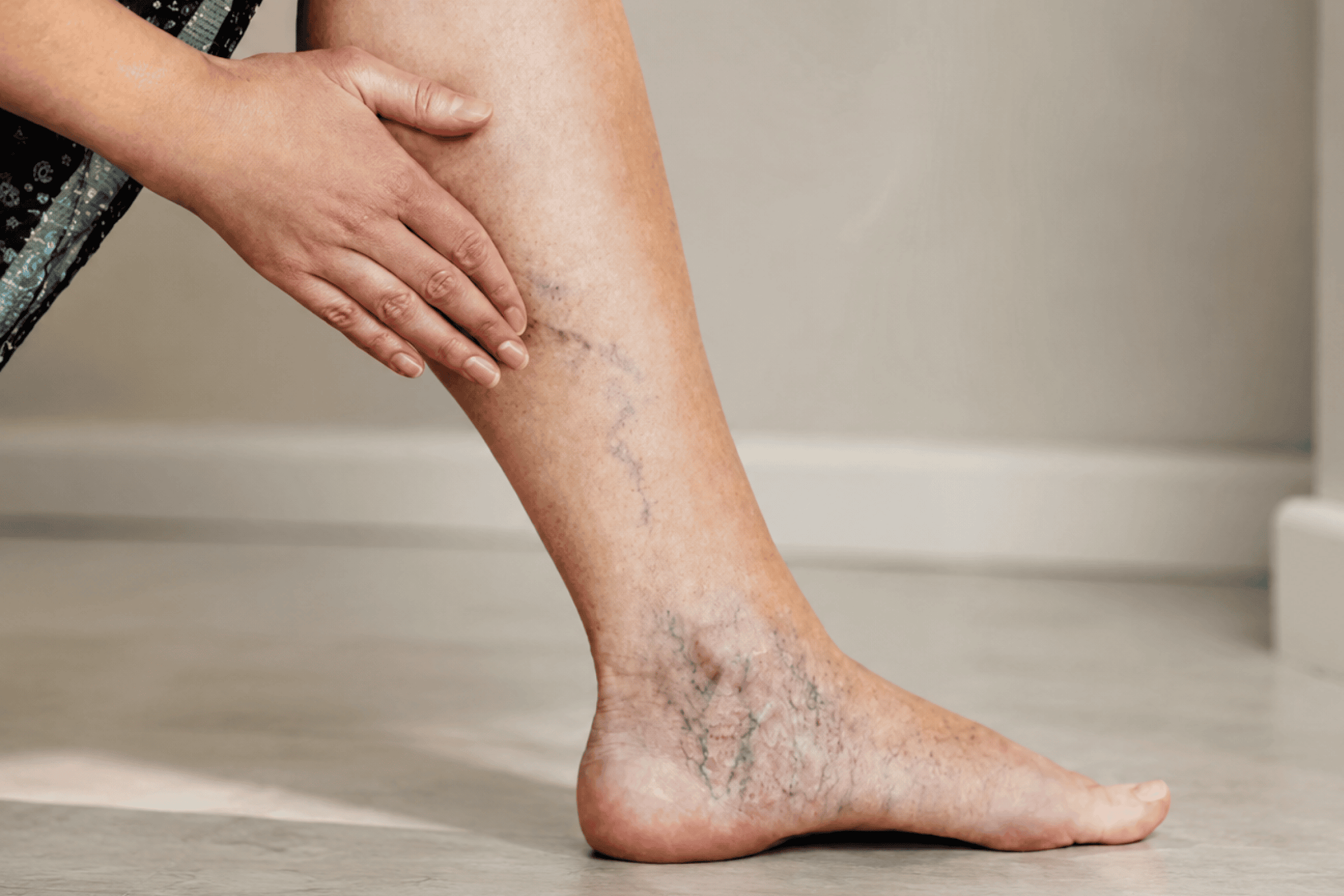 Varicose Veins During and After Pregnancy: What’s Normal, What’s Not